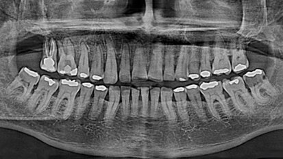 Complicaciones maxilofaciales en un paciente con cáncer de próstata