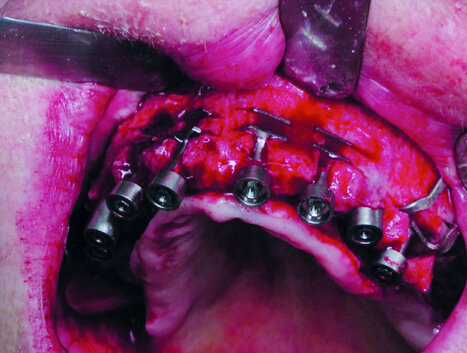 Figure1 : Diskimplants asymétriques