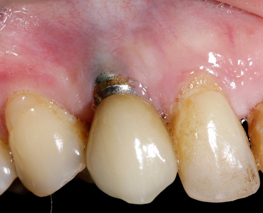Fig 1: Thin tissue biotype predisposes to mucogingival problems around implants and teeth