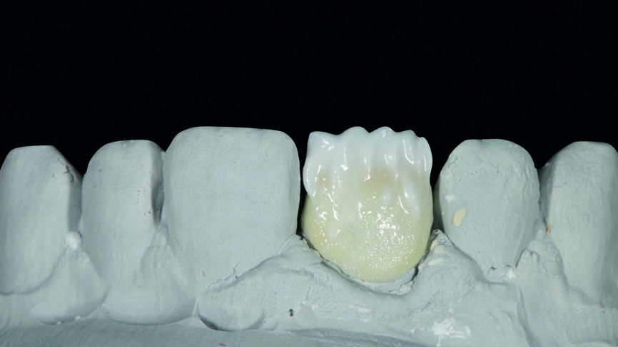 Fig. 5 : Ébauche amélaire avec la teinte E59. 
