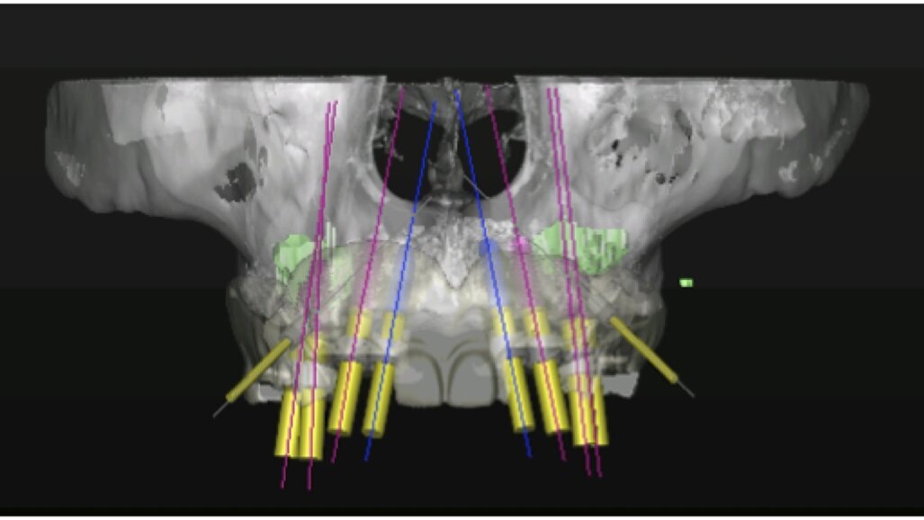 Técnicas quirúrgicas en el maxilar atrófico
