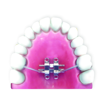 Fig.4 Bone- tooth anchored design: 2 anterior TADs 2 posterior TADs and support of molars