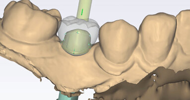 Řízená implantologie za použití řešení Planmeca all-in-one