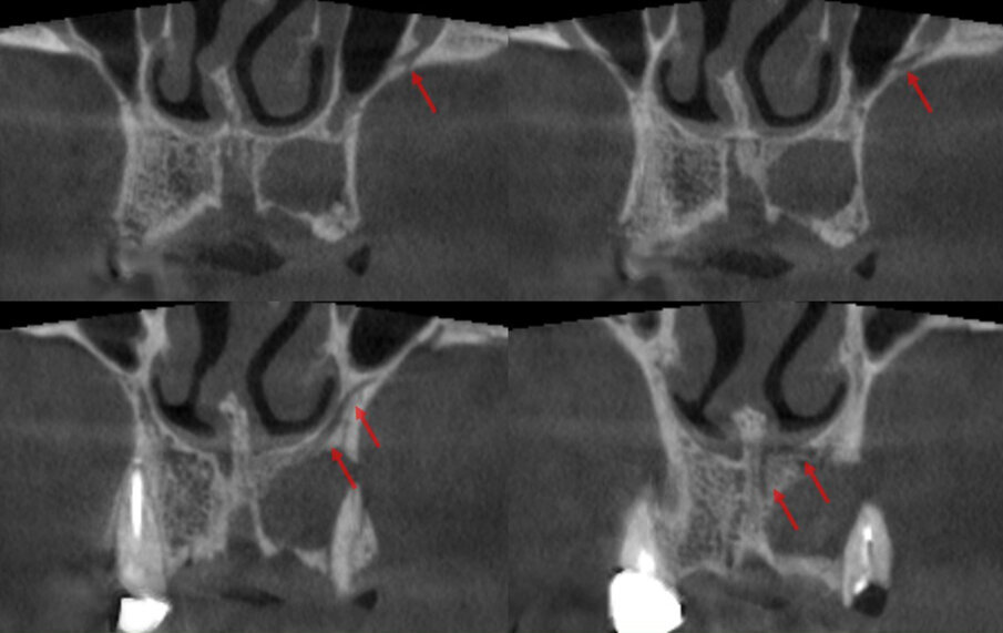 Fig. 3 - Decorso del CS evidenziato nella ricostruzioni coronali di una CBCT.