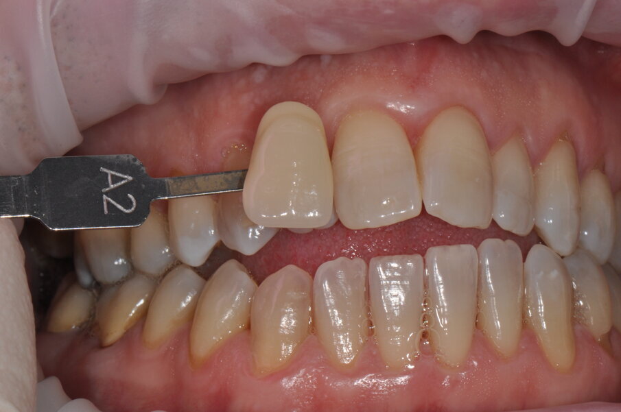 Fig. 9 - Colore post sbiancamento professionale utilizzando la scala “Vita” A2.