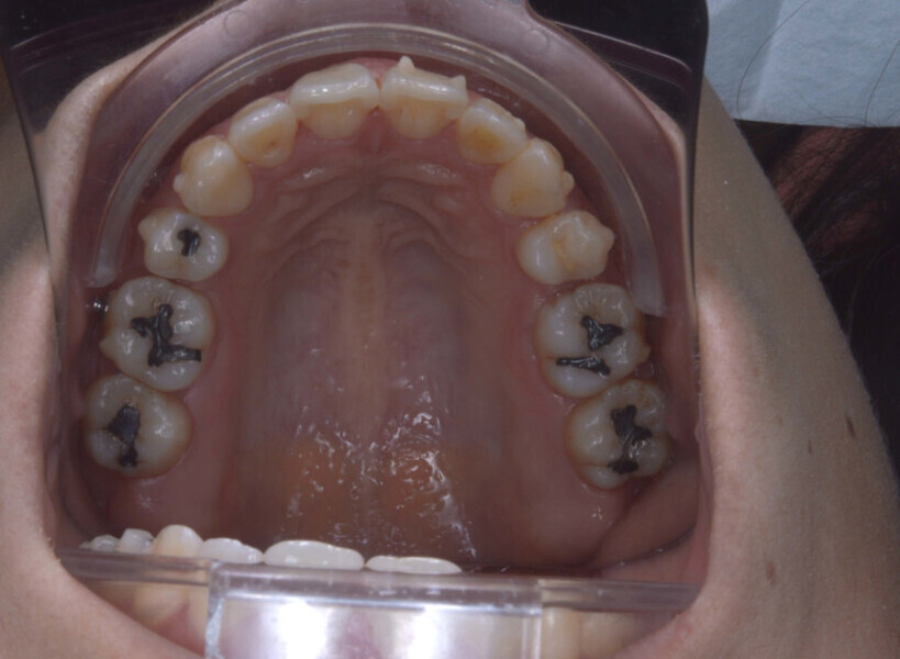 Fig. 6e: Intra-oral and occlusal photographs during treatment (after the 32nd aligner pair).