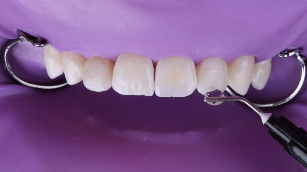 Fig. 14: Glycerine gel aanbrengen vóór het uitharden met licht om de vorming van een inhibitielaag te voorkomen.