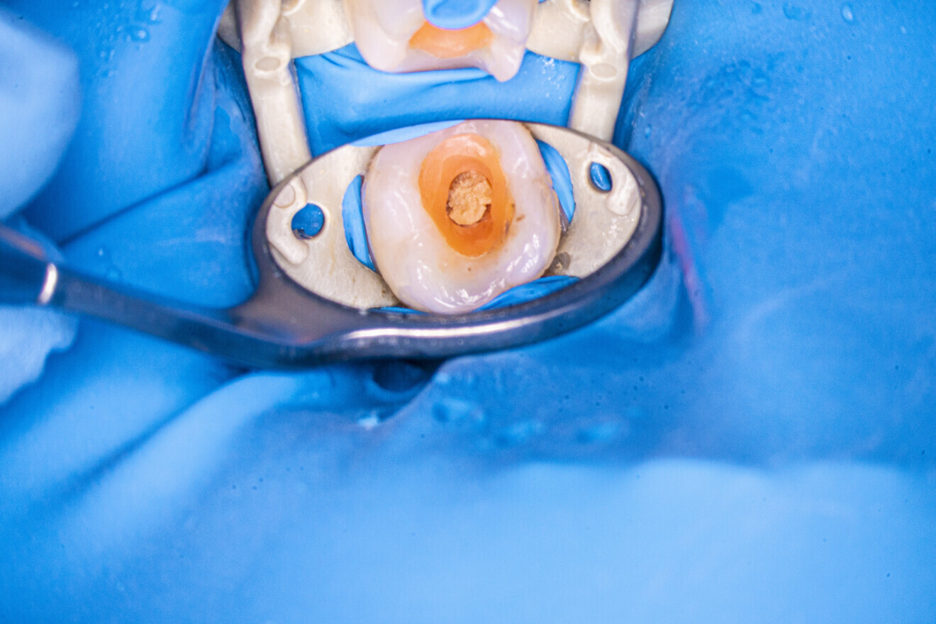 Fig. 4: Treated tooth after dental dam isolation. Damaged temporary restoration.