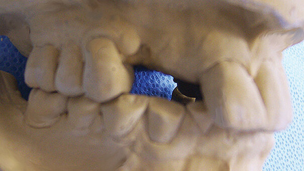 Lom implantata: Osvrt na fizičke mehanizme kliničkog neuspeha