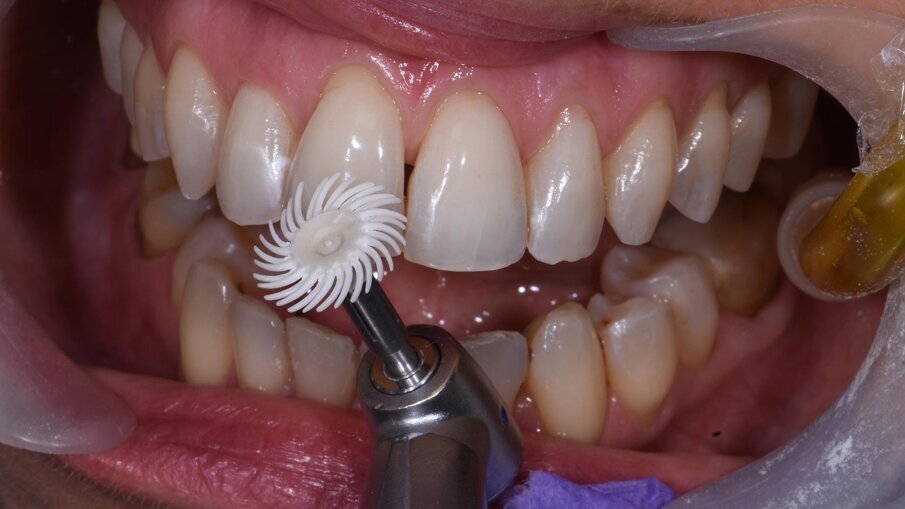 Fig. 5 - Lucidatura con disco di gomma sof-Lex Diamond 3M.