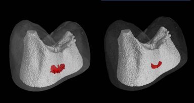 New device to treat caries with electric remineralisation