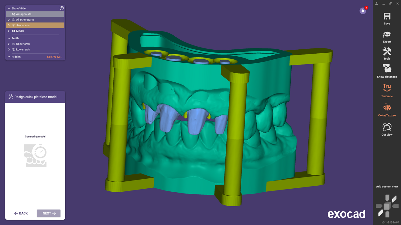 The new Quick Models feature simplifies and automates the preparation for model printing. (Image: exocad)