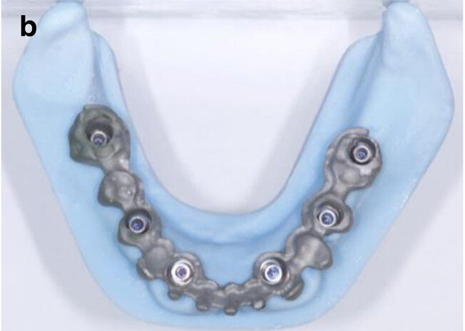 Fig. 7b: CAD/CAM model with the prefabricated titanium abutments (a), CAD/CAM cobalt–chromium framework (b) and composite veneered provisional FDP (c & d) before bonding to the abutments.