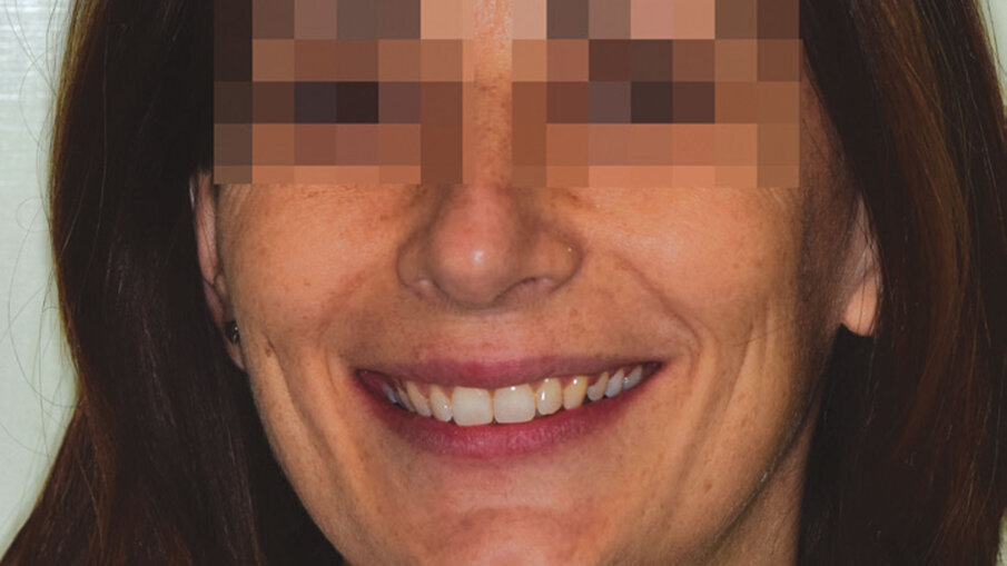 Figg. 10c, 10d_Foto extraorali ed intraorali di fine trattamento.