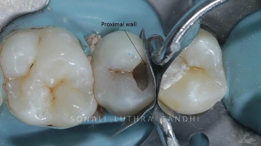 Figure 8 Centripetal layering technique