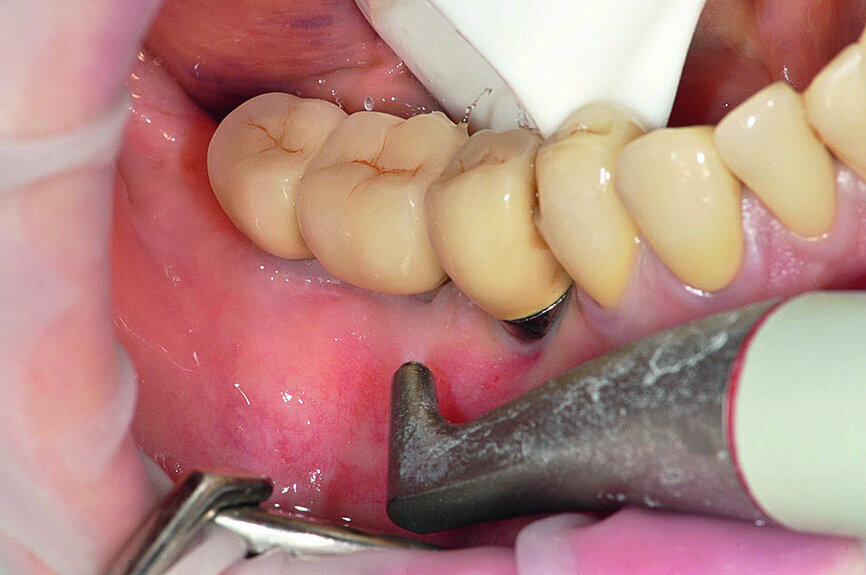 Fig. 5a: Professional peri-implant biofilm removal by a) AIRFLOW with erythritol powder (PLUS powder, EMS), b) PERIOFLOW with PLUS powder and c) with PEEK tip (PI, EMS).