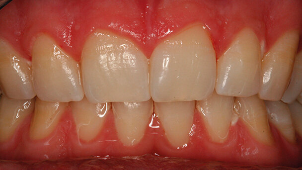 Valutazione dell’efficacia  dello sbiancamento professionale domiciliare con il nuovo Ena White 2.0: risultati a sei mesi allo spettrofotometro