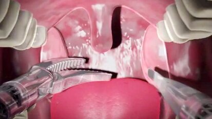 חוקרים מקדמים טכניקת ניתוח רובוטי לטיפול בגידולי ראש והצוואר שלא ניתן לניתוח