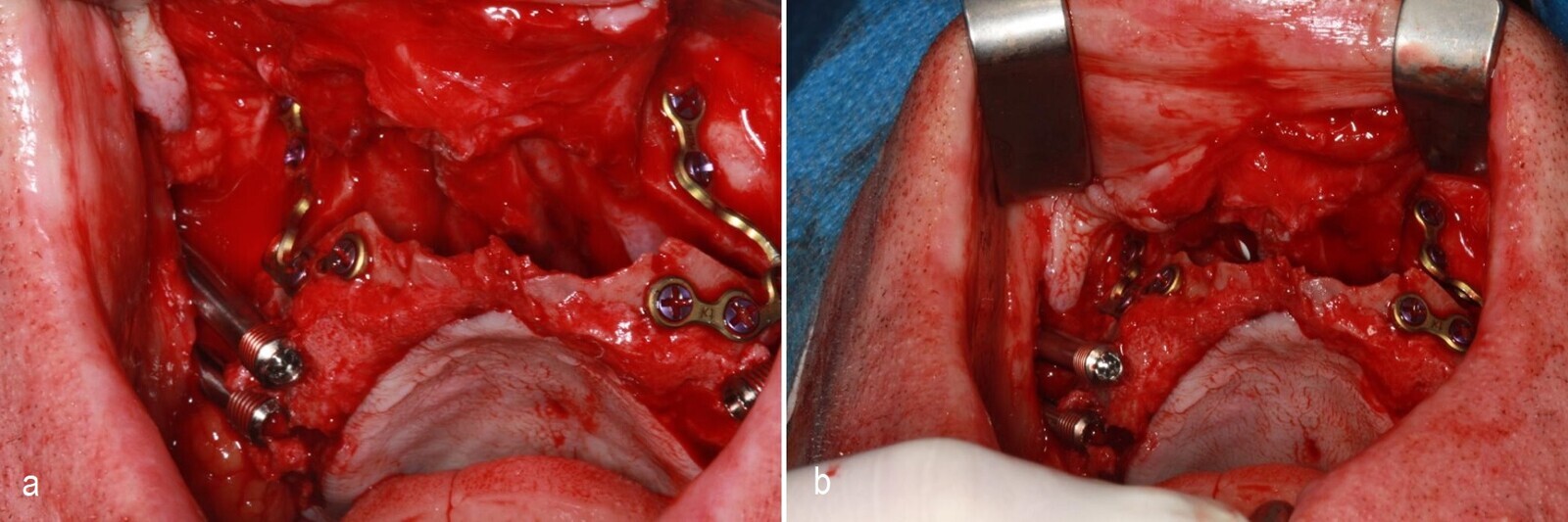 Figs. 5a & b: Intra-operative view of the Le Fort I osteotomy.