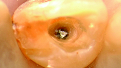 Le retraitement des infections périapicales: chirurgie ou pas ?