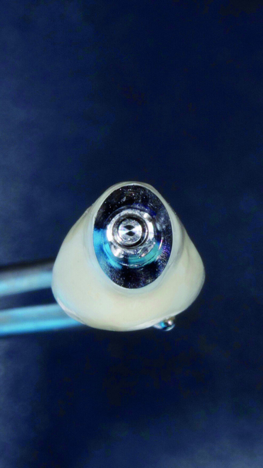 Fig. 10: Temporary crown was installed to support the formation of soft tissues.