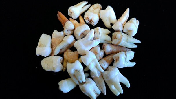 Sotto lo smalto… manca la vitamina D