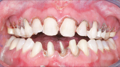 Redukce “gummy smile” zvýšením skusu