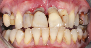 Greffons radiculaires : traitement des défauts osseux antérieurs par racines dentaires ankylosées