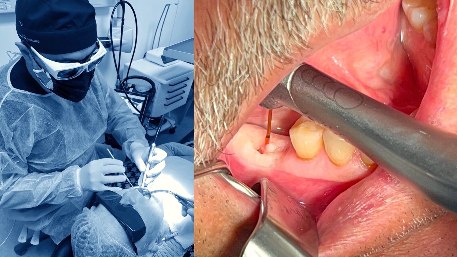 El láser en Implantología (5)