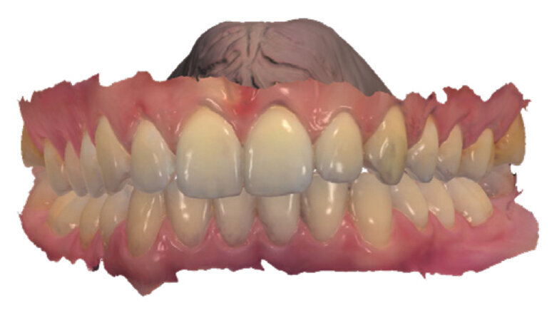 Malokluze I. třídy léčená pomocí F22 Aligners