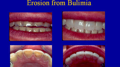 Dentists are often able to spot eating disorders in patients