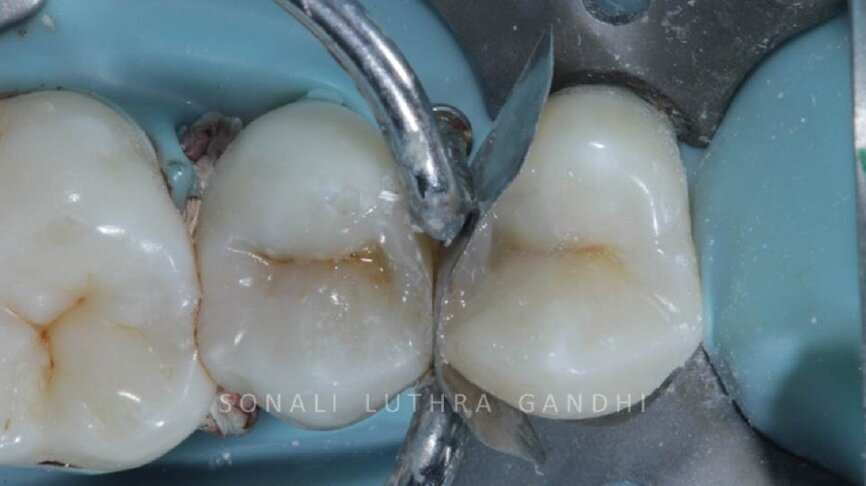 Figure 11 Band adaption and completed restoration of 14