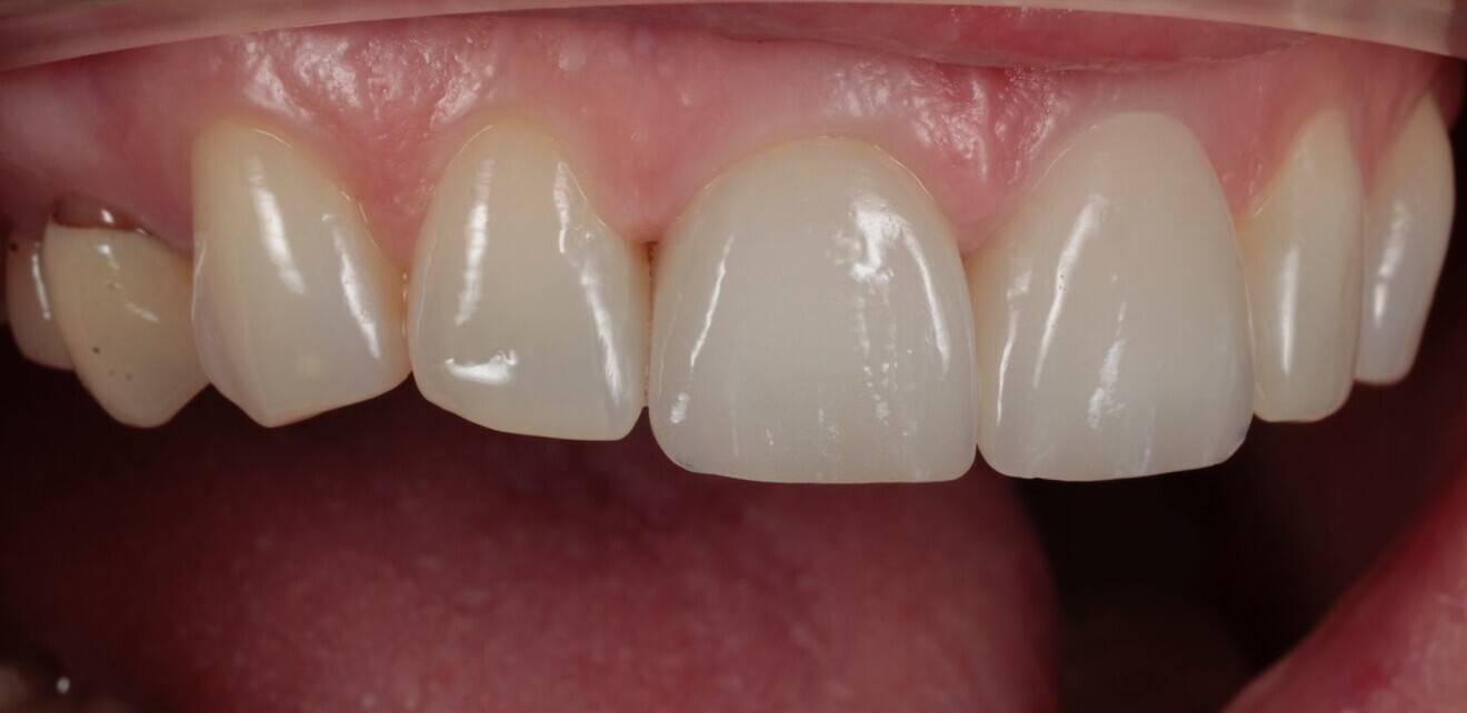 Fig. 13: 2021—the two maxillary central incisor restorations replaced with a lithium disilicate crown and veneer.