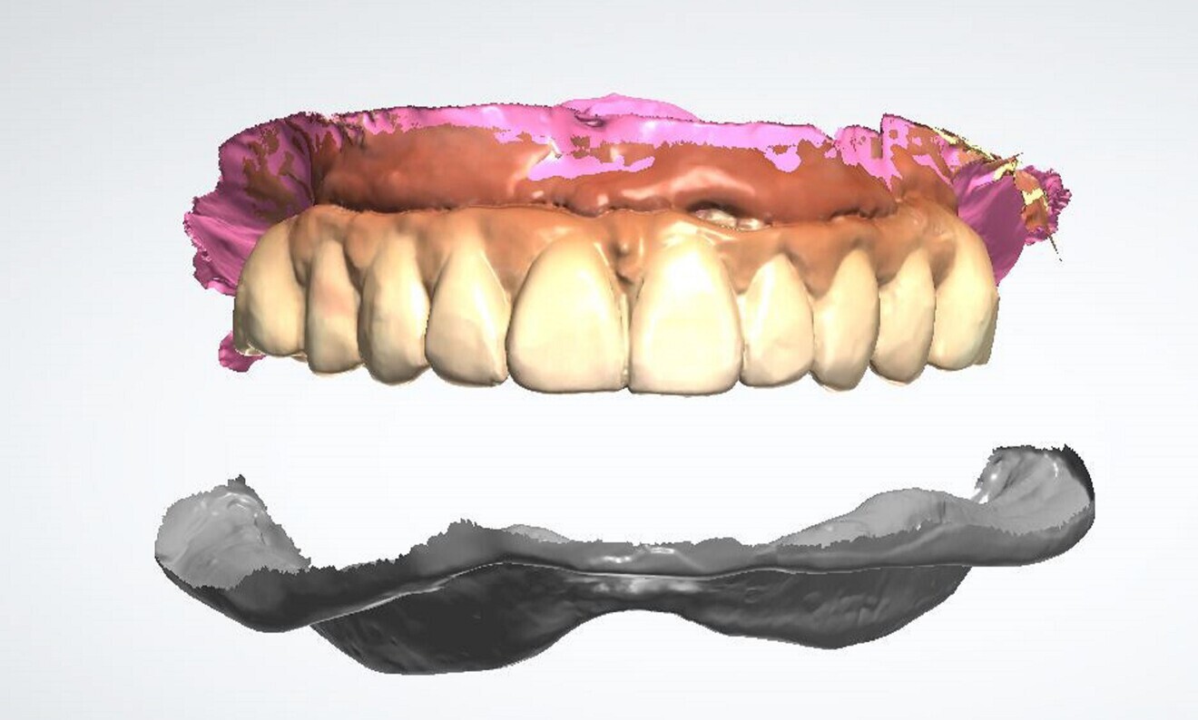 Fig. 4: Intra-oral scans of the maxillary and mandibular arches.