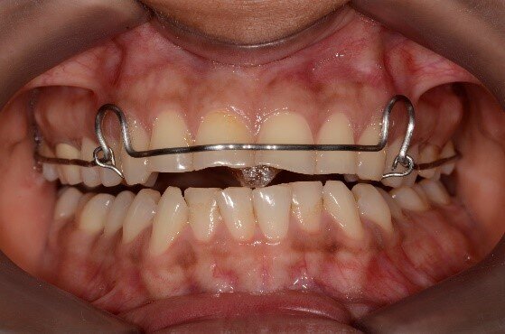 Fig 7: A Kois deprogrammer allows the muscles to relax without the teeth interferences and that helps to the condyles finding their physiologically optimal position within the joint