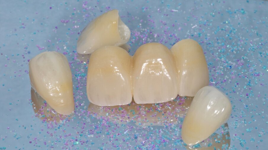 Fig. 6: KATANA Zirconia UTML fixed dental prostheses.