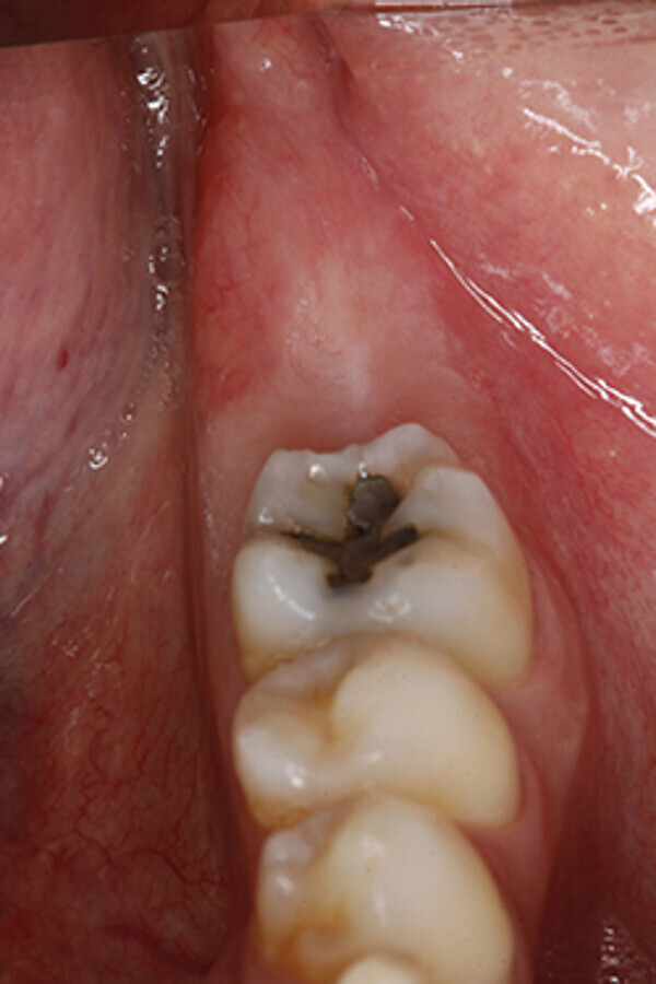 Figura 1. FotografÃ­a intraoral. Imagen preoperatoria. Se observa el tercer cuadrante parcialmente dentado, nÃ³tese la ausencia clÃ­nica de los dientes 3.7 y 3.8