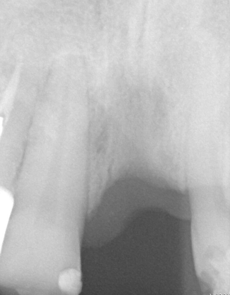 Fig. 1_Rx preoperatoria.