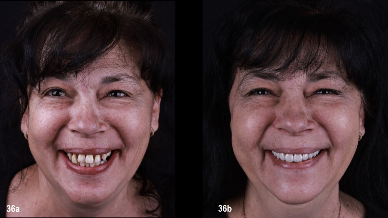 Figs. 36a & b: Patient’s smile before (a) and after the treatment (b).