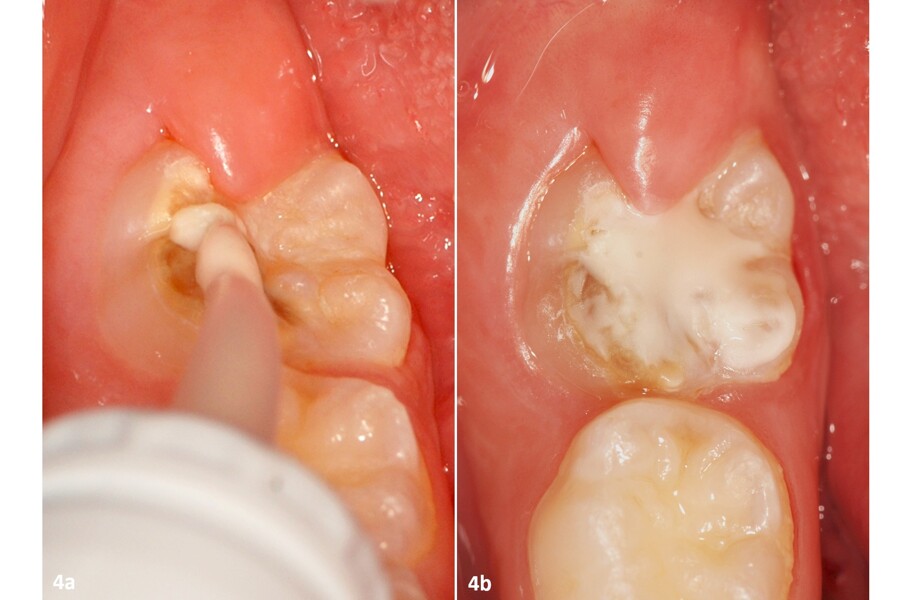 Figs. 4a y b: Sellado de dientes afectados por MIH con GC Fuji TRIAGE.