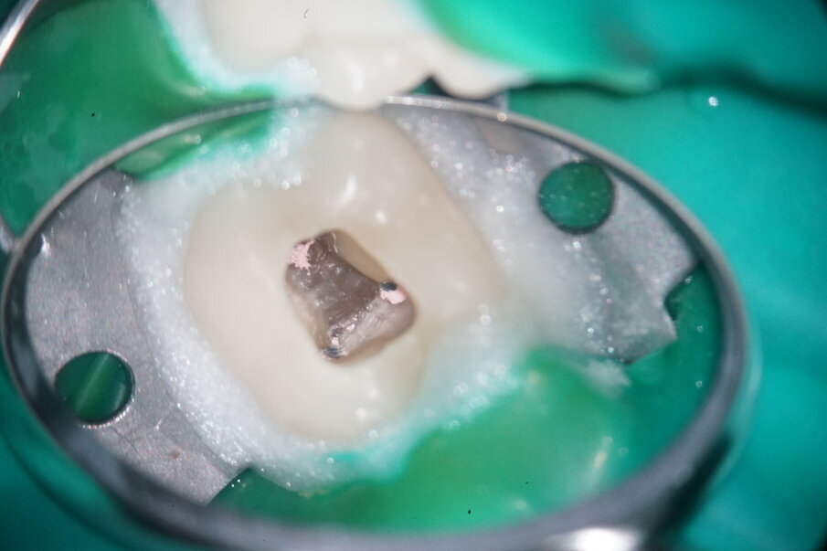 Fig. 3: Initial situation of mesial canals.