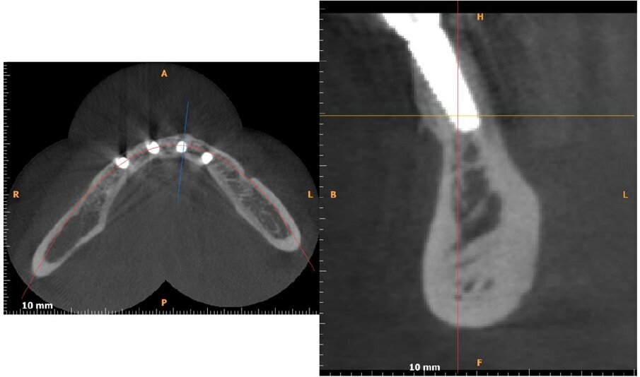 Fig. 16 - Follow-up a 12 mesi: l’esame CBCT postoperatorio dimostra la presenza di tessuto osseo corticalizzato in corrispondenza degli impianti.