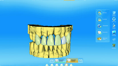 Upotreba  VITA SUPRINITY-  studija kliničkog slučaja