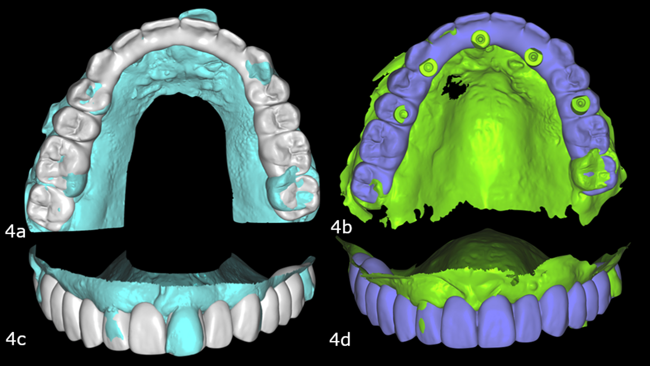 Figs. 4a–d: Pre-op maxillary intra-oral scan with the digital wax-up (a & b) converted to the prosthesis on the implant scan (c & d).
