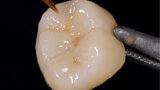 Fig. 4. Maquillaje y glaseado de la corona.