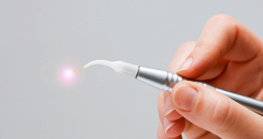 Löcher in Zähnen mit dem Laser auffüllen