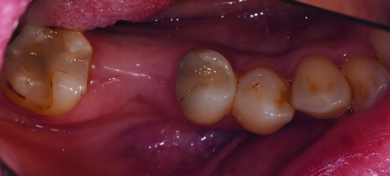 Fig. 2 : Vue occlusale du secteur 46. 