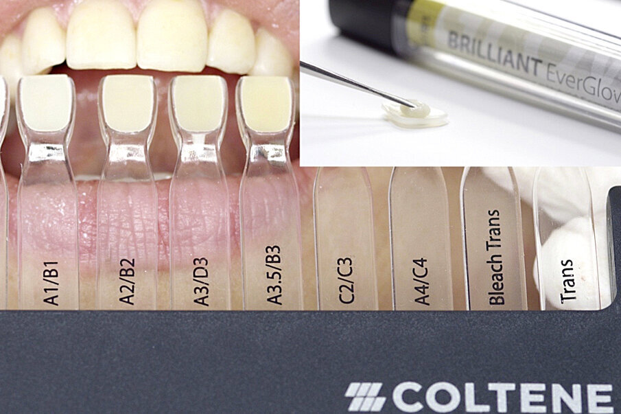 Fig. 5: Shade selection with BRILLIANT EverGlow shade guide