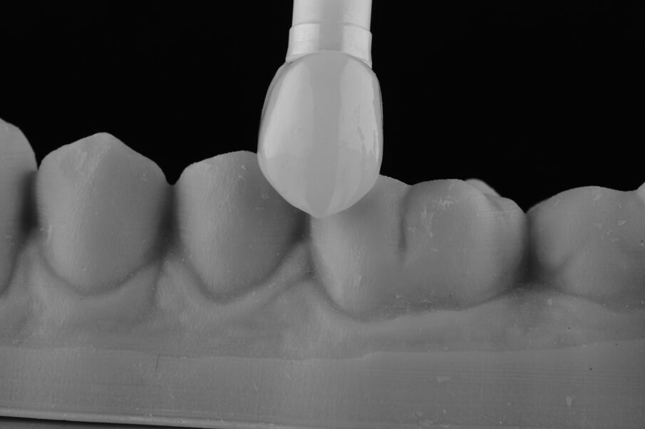 Fig. 11 - Visione della corona ultimata, del moncone a cui è incollata e dell’analogo ceramico. 