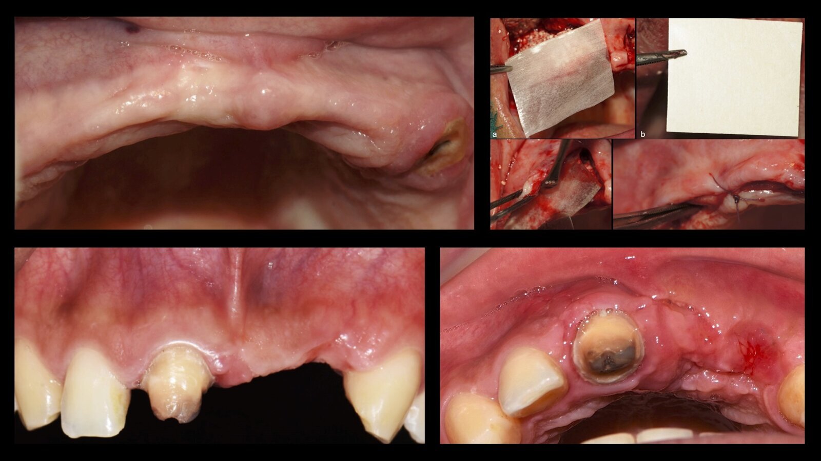 Piezocirugía  (11). Casos clínicos de terapia ósea regenerativa con piezoeléctrico